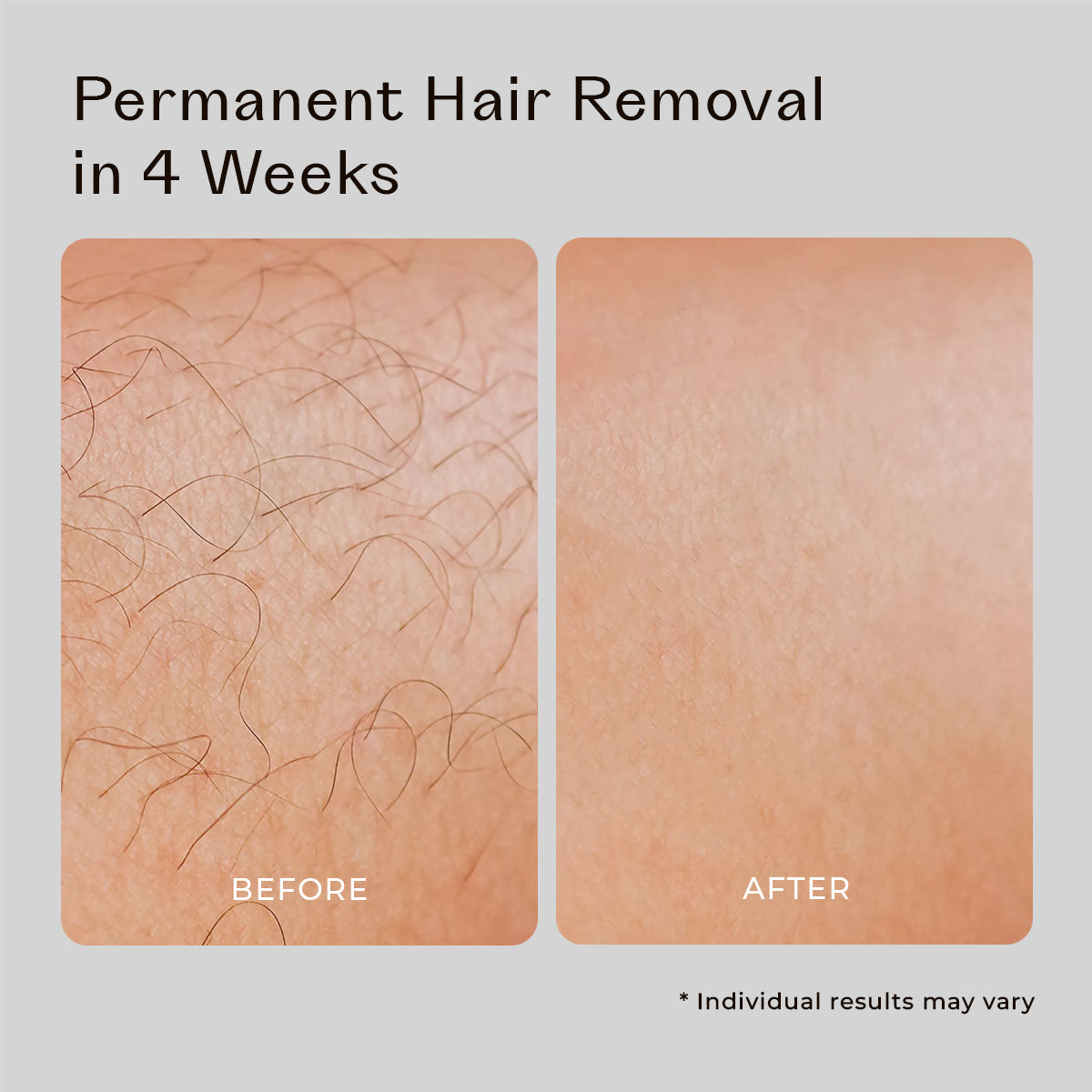 5MINSKIN AT-HOME LASER HAIR REMOVAL HANDSET - 50% OFF MOTHER'S DAY SALE