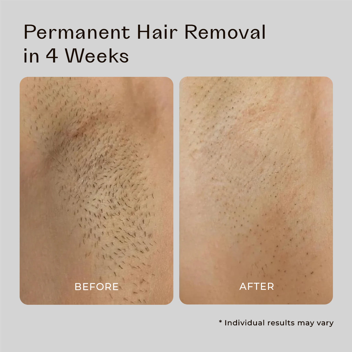 5MINSKIN AT-HOME LASER HAIR REMOVAL HANDSET - 50% OFF MOTHER'S DAY SALE