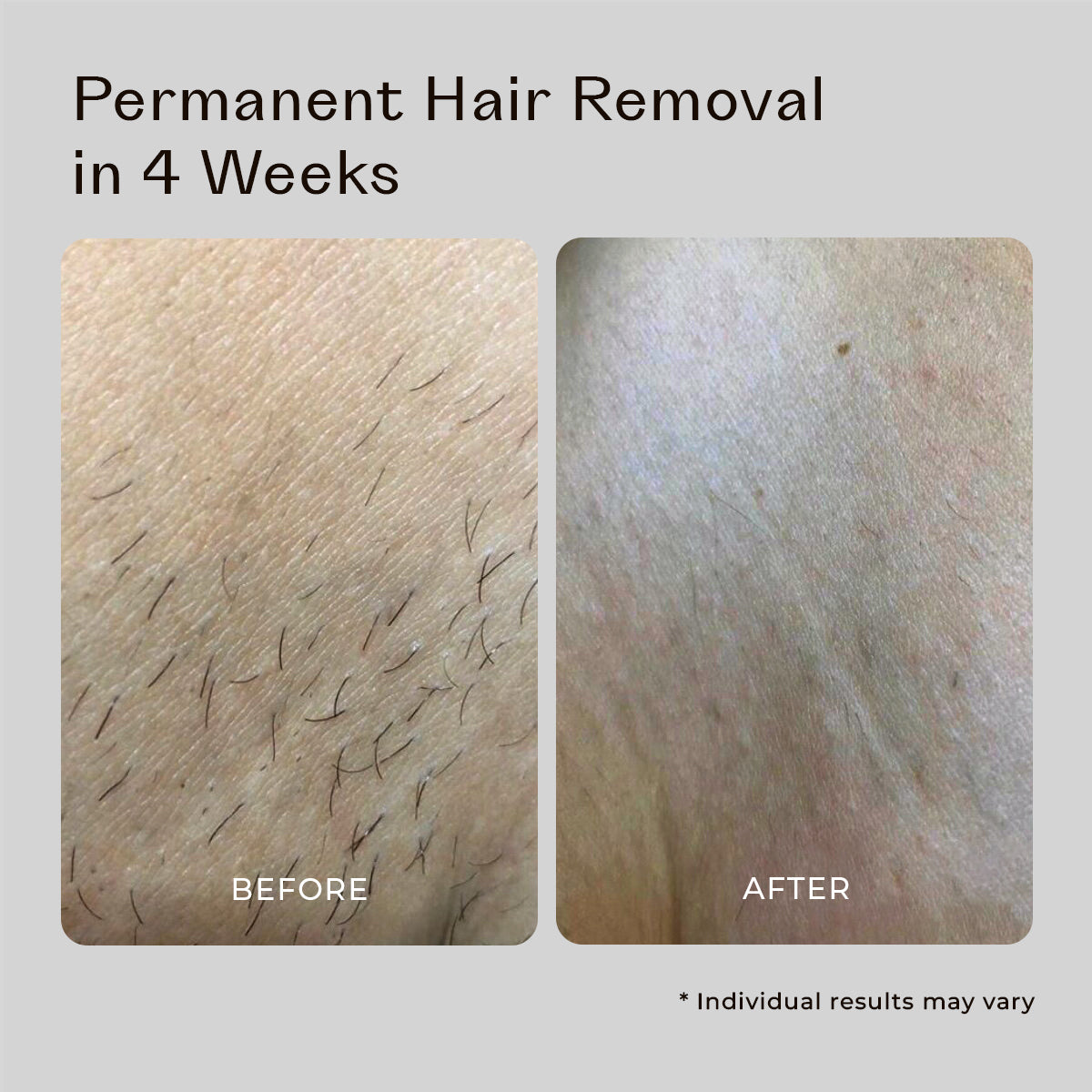 5MINSKIN AT-HOME LASER HAIR REMOVAL HANDSET - 50% OFF MOTHER'S DAY SALE